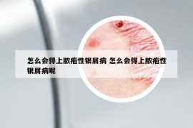 怎么会得上脓疱性银屑病 怎么会得上脓疱性银屑病呢