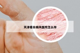 天津看白癜风医院怎么样