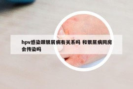 hpv感染跟银屑病有关系吗 和银屑病同房会传染吗