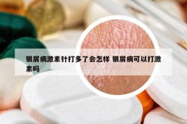 银屑病激素针打多了会怎样 银屑病可以打激素吗