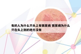 有的人为什么只头上有银屑病 银屑病为什么只在头上别的地方没有