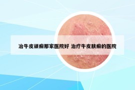 冶牛皮顽癣那家医院好 治疗牛皮肤癣的医院