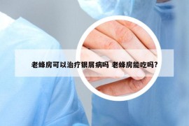 老蜂房可以治疗银屑病吗 老蜂房能吃吗?