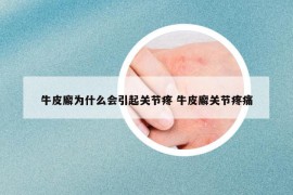 牛皮廨为什么会引起关节疼 牛皮廨关节疼痛