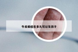 牛皮癣痊愈多久可以生孩子