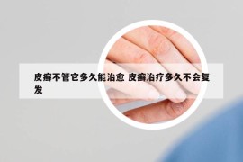 皮癣不管它多久能治愈 皮癣治疗多久不会复发