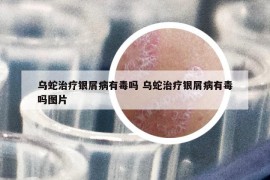 乌蛇治疗银屑病有毒吗 乌蛇治疗银屑病有毒吗图片