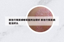 脓包行银屑病哪家医院治得好 脓包行银屑病能治好么