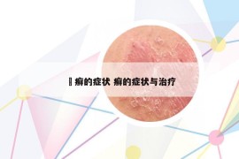 莥癣的症状 癣的症状与治疗