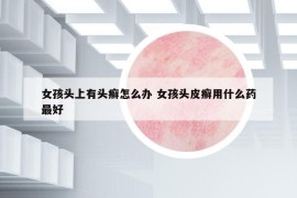 女孩头上有头癣怎么办 女孩头皮癣用什么药最好