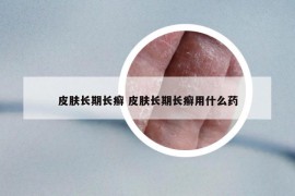 皮肤长期长癣 皮肤长期长癣用什么药