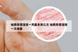 哈西奈德溶液一天最多用几次 哈西奈德溶液一次用量