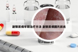 副银屑病早期治疗方法 副银屑病图片前兆