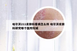 哈尔滨211皮肤科看病怎么样 哈尔滨皮肤科研究哪个医院权威