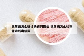 银屑病怎么确诊快速问医生 银屑病怎么检查能诊断出病因