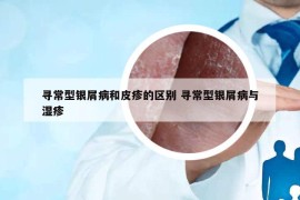 寻常型银屑病和皮疹的区别 寻常型银屑病与湿疹