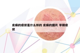 皮癣的症状是什么样的 皮癣的图片 早期症状