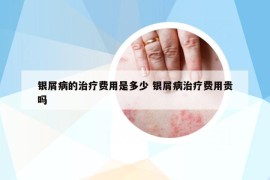 银屑病的治疗费用是多少 银屑病治疗费用贵吗