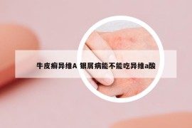 牛皮癣异维A 银屑病能不能吃异维a酸