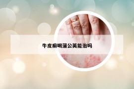 牛皮癣喝蒲公英能治吗