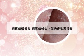 银屑病留长发 银屑病长头上怎治疗头发很长