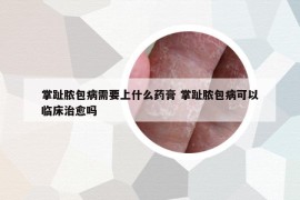 掌趾脓包病需要上什么药膏 掌趾脓包病可以临床治愈吗