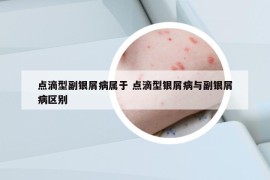 点滴型副银屑病属于 点滴型银屑病与副银屑病区别