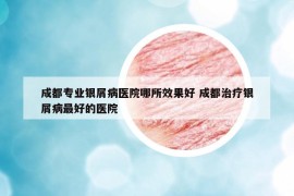 成都专业银屑病医院哪所效果好 成都治疗银屑病最好的医院