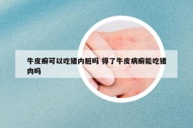 牛皮癣可以吃猪内脏吗 得了牛皮病癣能吃猪肉吗