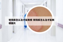 铜钱癣怎么治才能断根 铜钱癣怎么治才能断根图片