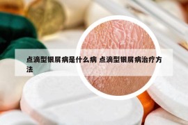 点滴型银屑病是什么病 点滴型银屑病治疗方法