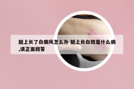 腿上长了白癜风怎么办 腿上长白斑是什么病,请正面回答