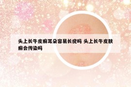 头上长牛皮癣耳朵容易长疣吗 头上长牛皮肤癣会传染吗