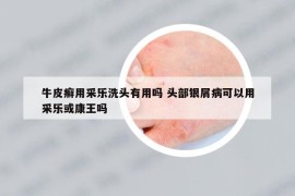 牛皮癣用采乐洗头有用吗 头部银屑病可以用采乐或康王吗