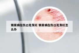 银屑病在伤口处发红 银屑病在伤口处发红怎么办