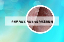 白癜风马齿苋 马齿苋治愈白斑案例贴吧