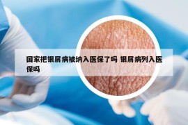 国家把银屑病被纳入医保了吗 银屑病列入医保吗