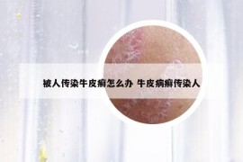 被人传染牛皮癣怎么办 牛皮病癣传染人