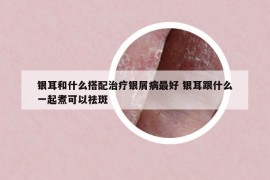 银耳和什么搭配治疗银屑病最好 银耳跟什么一起煮可以祛斑