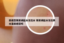 脓疱型银屑病起水泡流水 银屑病起水泡流黄水是脓疱型吗