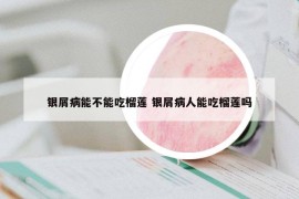 银屑病能不能吃榴莲 银屑病人能吃榴莲吗