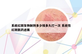 系统红斑生物制剂多少钱多久打一次 系统性红斑新药进展