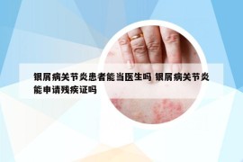 银屑病关节炎患者能当医生吗 银屑病关节炎能申请残疾证吗