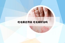 吃毛癣还传染 吃毛癣好治吗