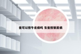 姜可以擦牛皮癣吗 生姜擦银屑病