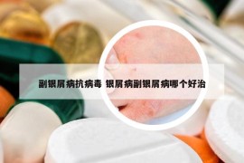 副银屑病抗病毒 银屑病副银屑病哪个好治