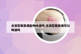 点滴型银屑病能喝啤酒吗 点滴型银屑病可以喝酒吗