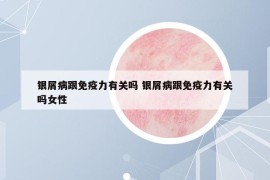 银屑病跟免疫力有关吗 银屑病跟免疫力有关吗女性