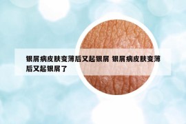 银屑病皮肤变薄后又起银屑 银屑病皮肤变薄后又起银屑了