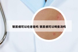 银屑病可以吃老姜吗 银屑病可以喝姜汤吗